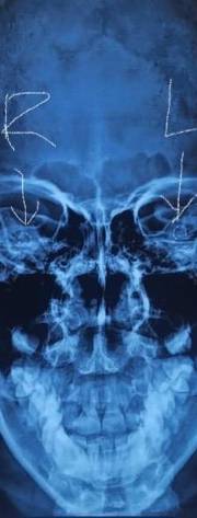 A Milestone Moment: Our First Simultaneous Adult Bilateral Cochlear Implant Surgery A Milestone Moment: Our First Simultaneous Adult Bilateral Cochlear Implant Surgery